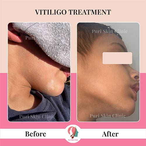 da 0000 hair 3 0005 vitiligo