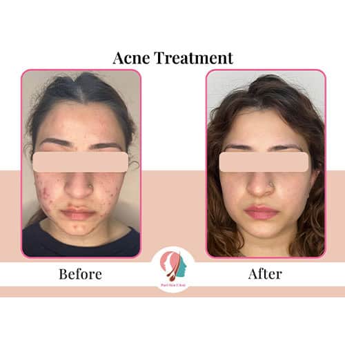 swsw 0002 acne and scars 1