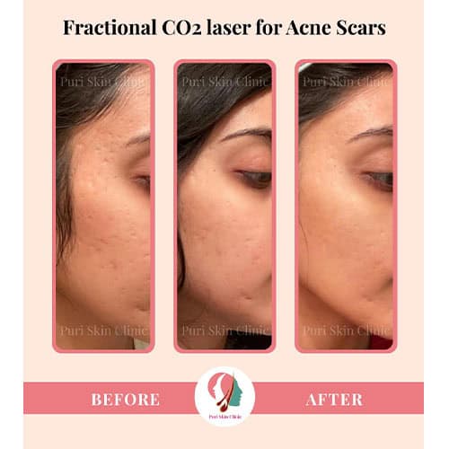 swsw 0005 acne scars 3
