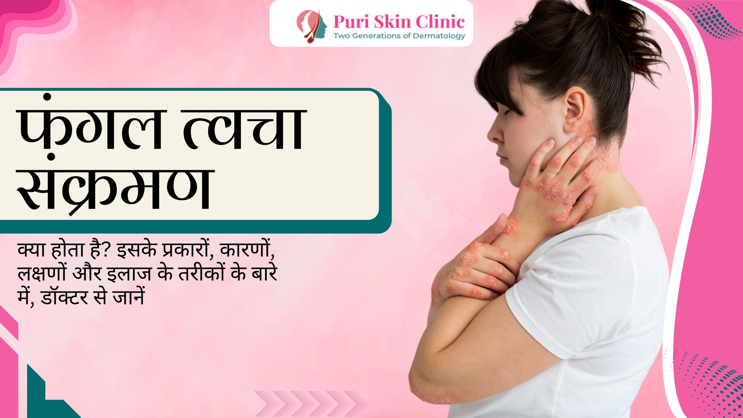 what are fungal skin infections learn about their types causes symptoms and treatment