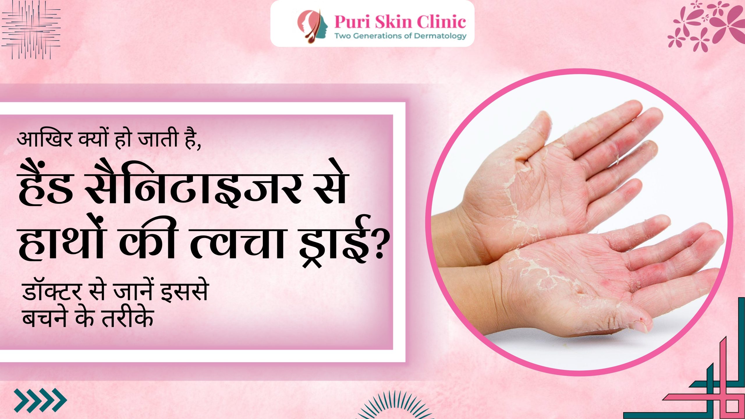 why does hand sanitizer dry out the skin on your hands learn ways to prevent this from a doctor