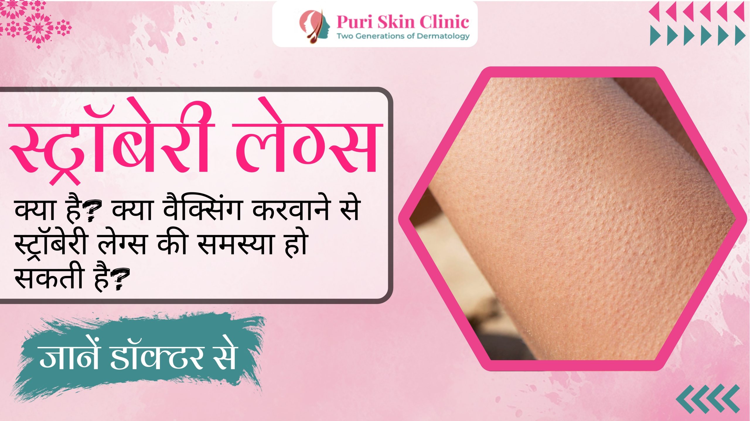 what are strawberry legs can waxing cause strawberry legs