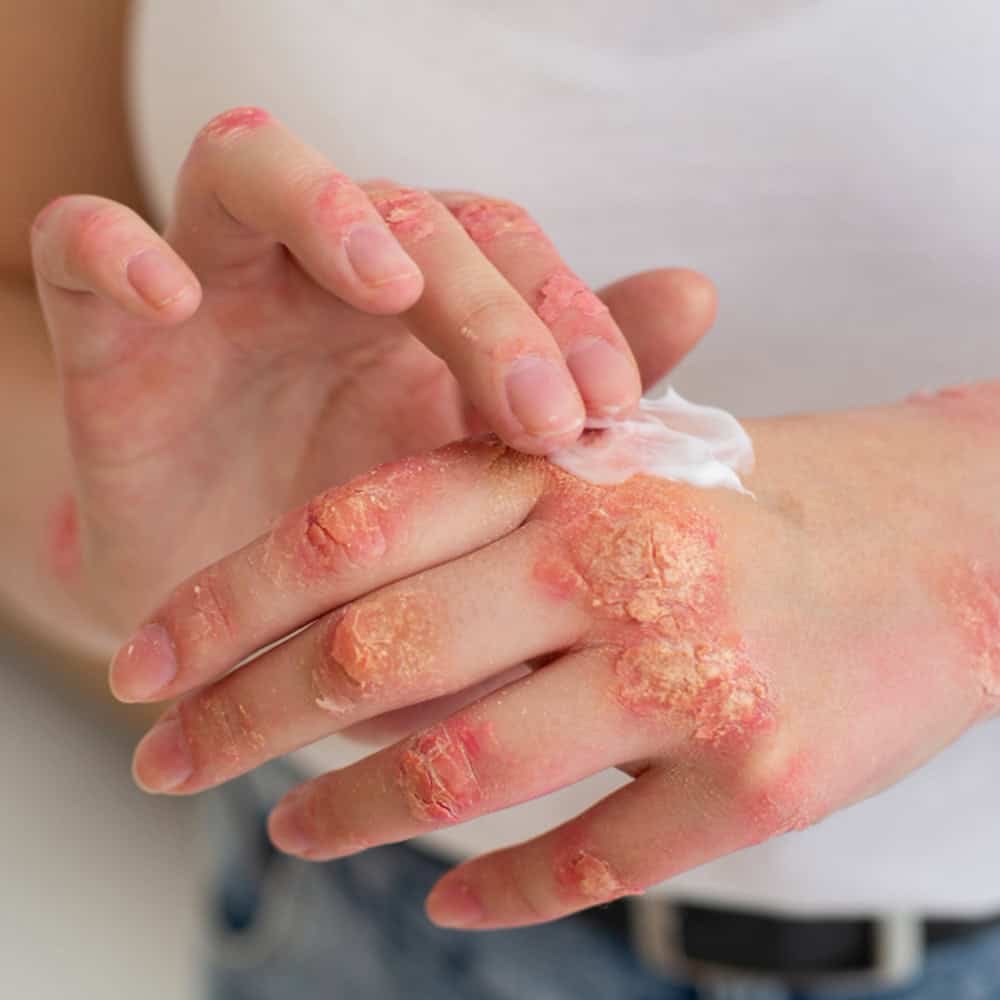 psoriasis treatment