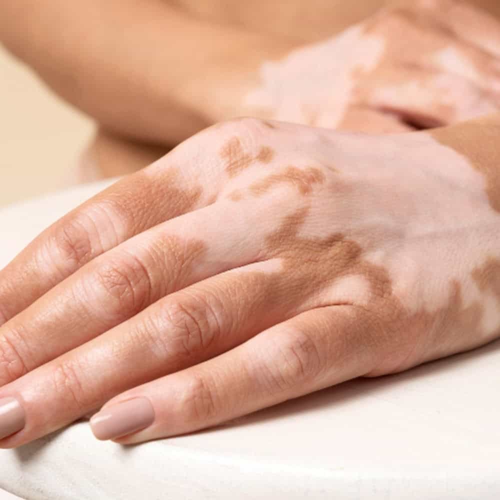 vitiligo treatment