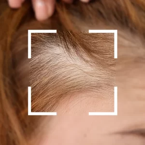 Anticadere si regenerare