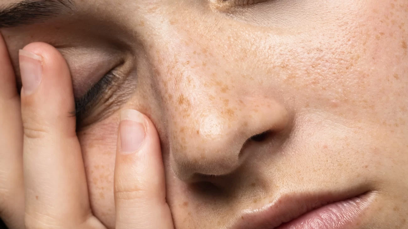 Tenul cu Melasma close up woman posing studio