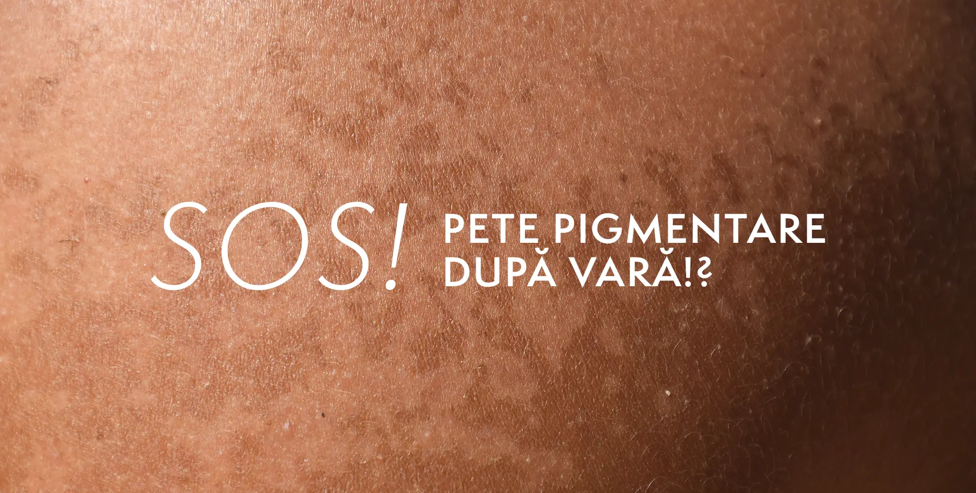 SOS Pete Pigmentare: Cum le identifici și tratezi eficient PETE pigmentare dupa vara