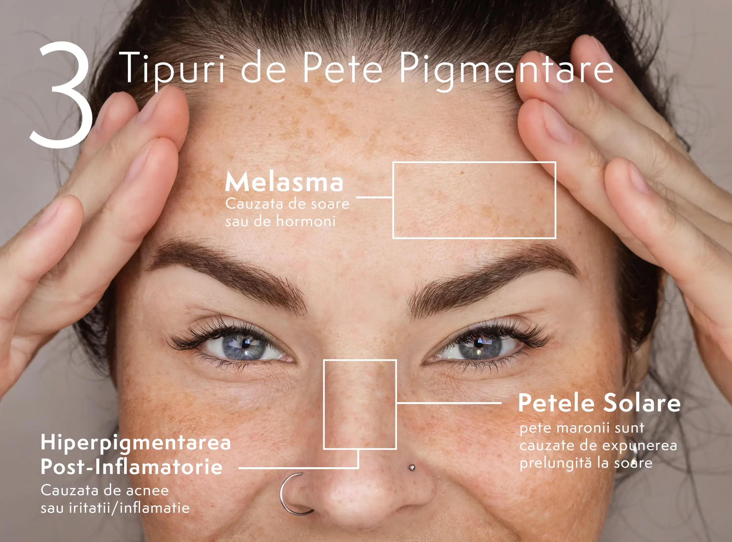 SOS Pete Pigmentare: Cum le identifici și tratezi eficient Pete pigmentare tipuri si tratament scaled