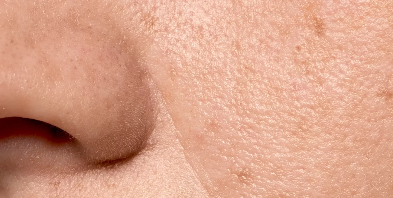 Acid salicilic tratament puncte negre