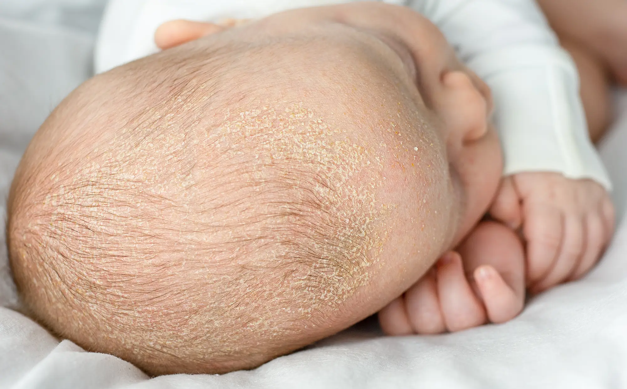 dermatita seboreica bebelusi