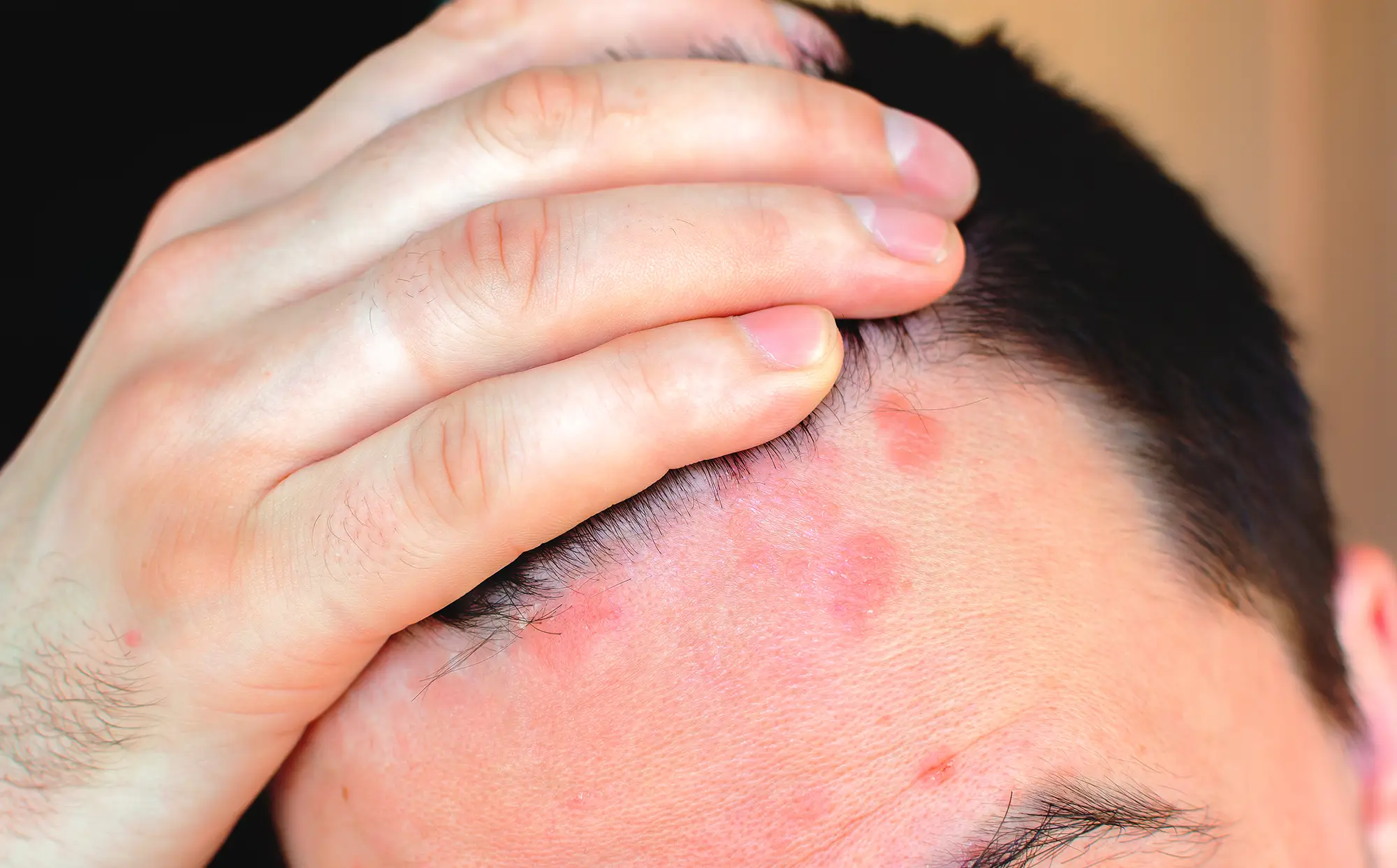 Dermatita seboreica scalp