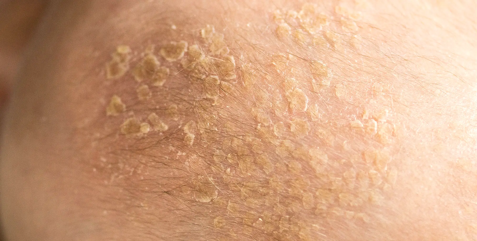 Dermatita seboreica tratament