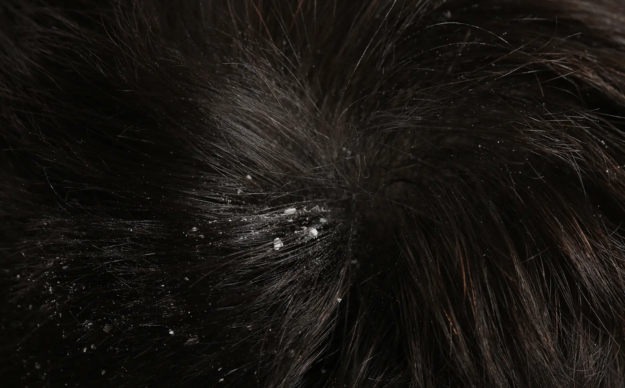 matreata scalp