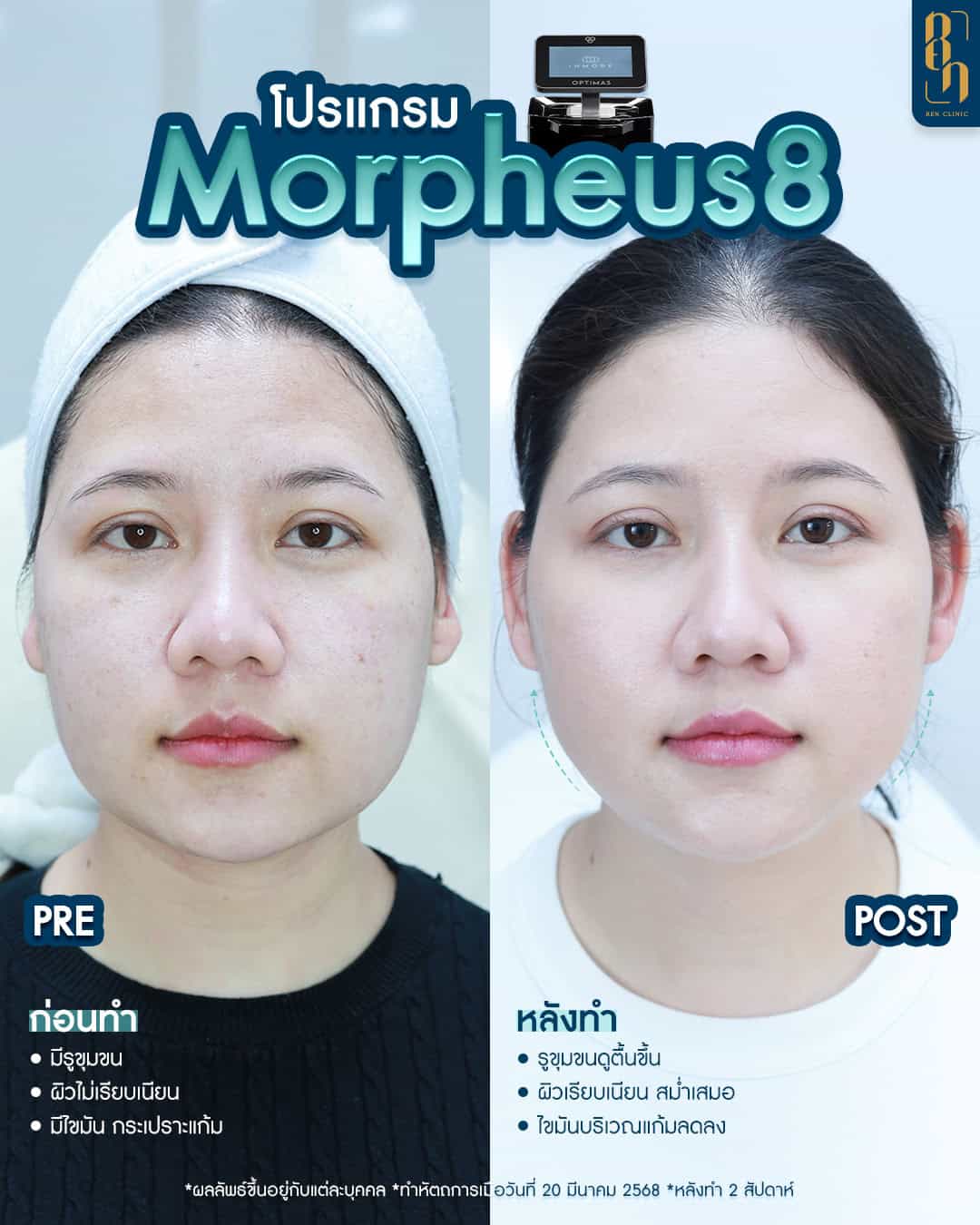 Morpheus8 รีวิว