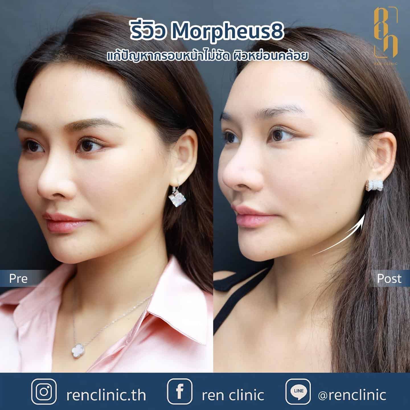 Morpheus8 รีวิว