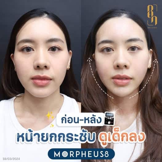 Morpheus8 รีวิว