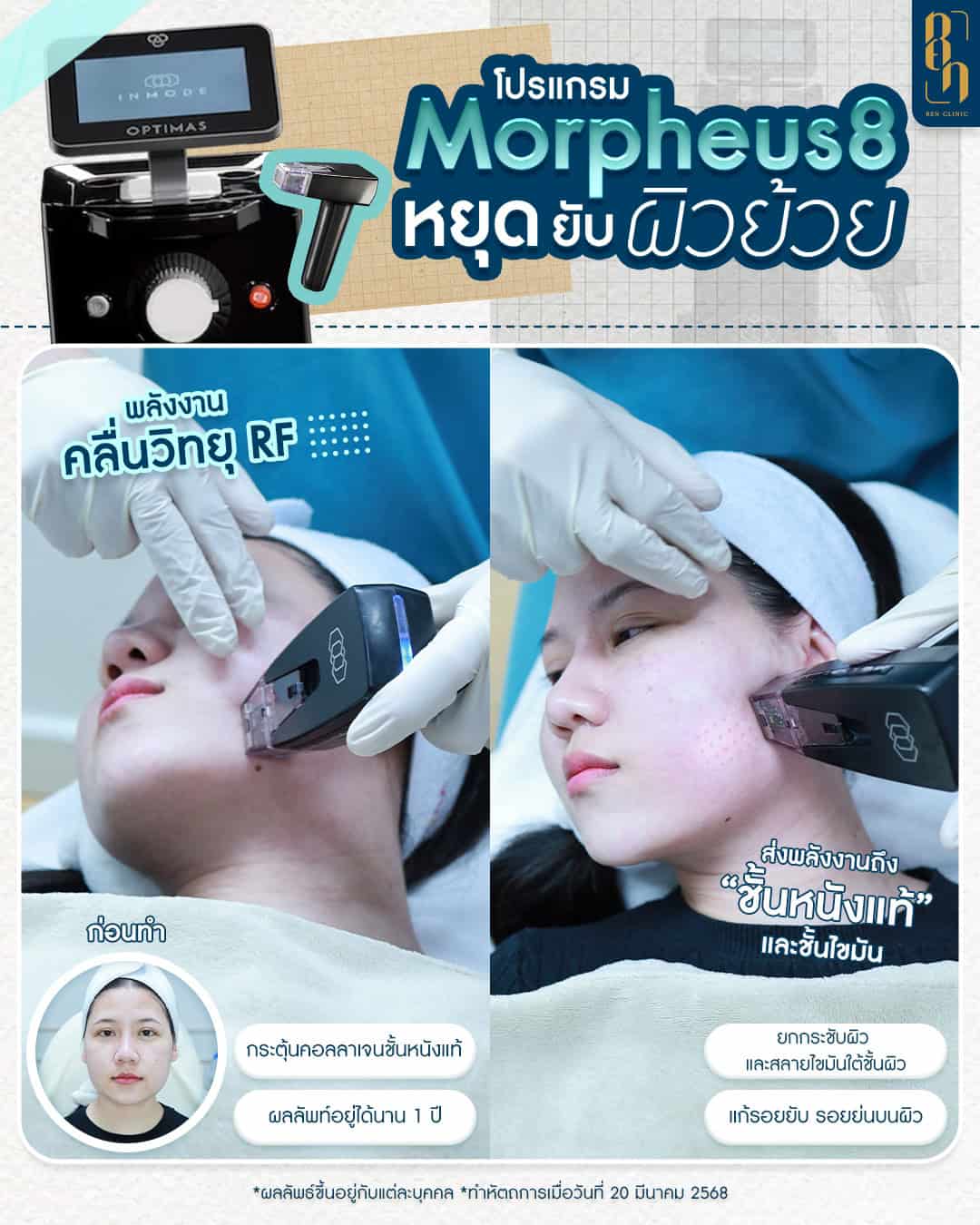 Morpheus8 ช่วยอะไร