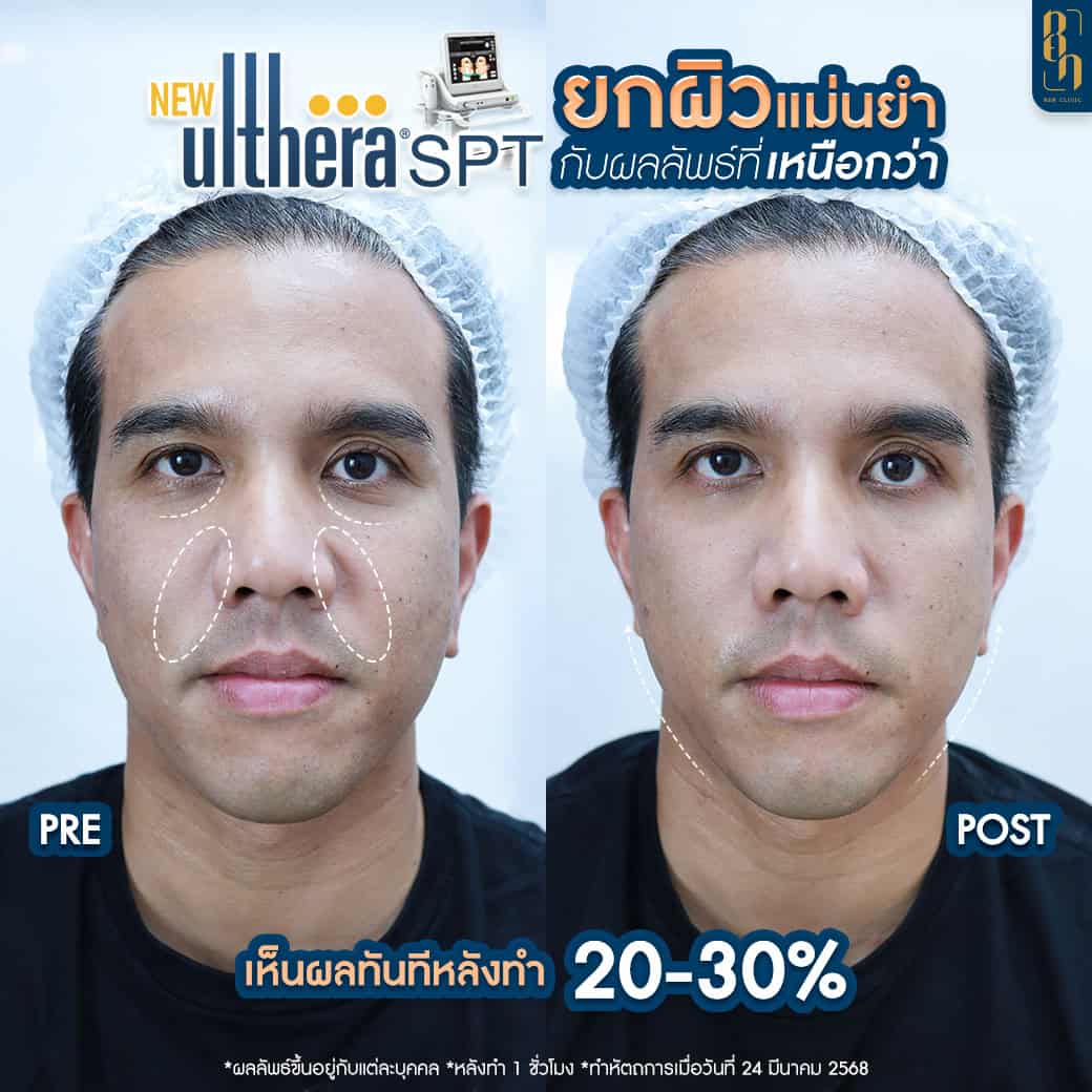 Ultherapy VS. Ultraformer