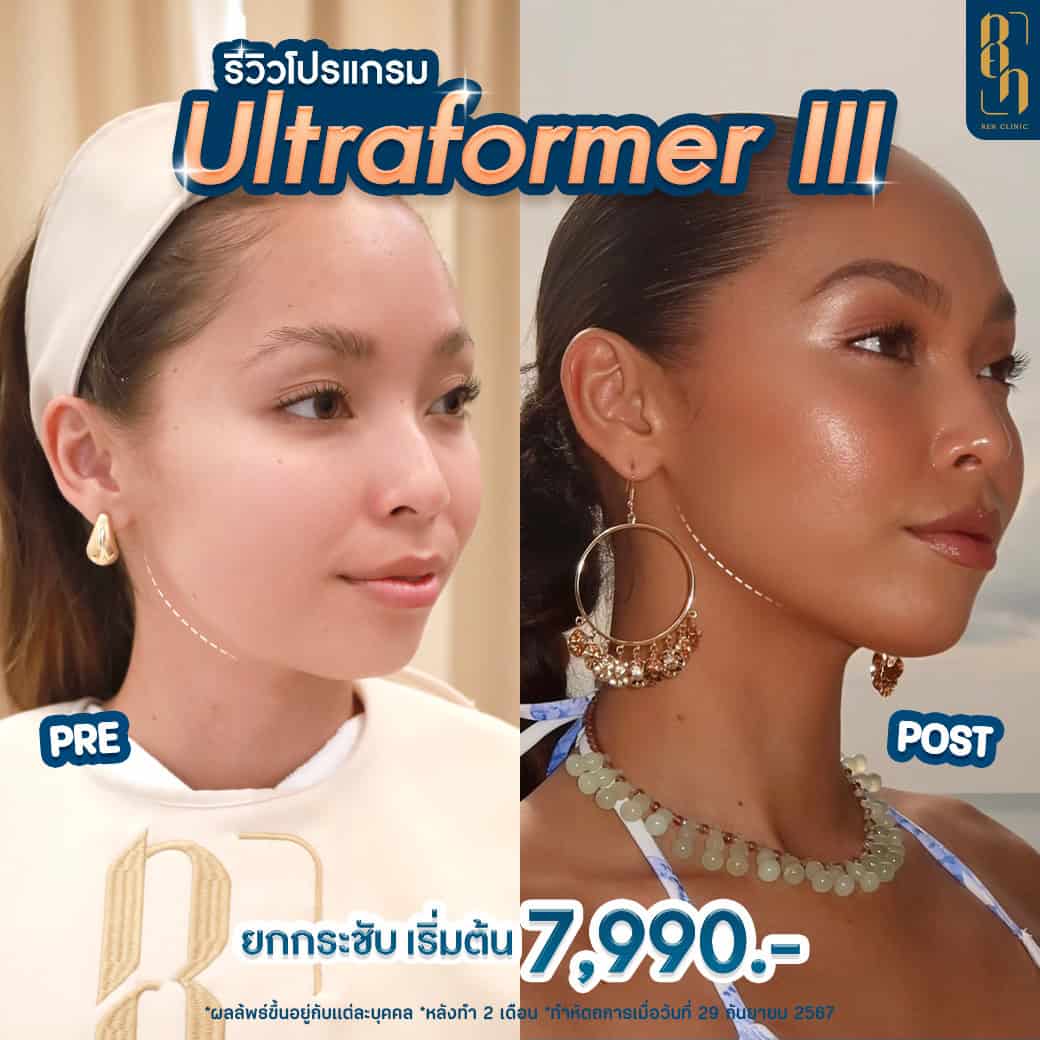 รีวิว Ultraformer III
