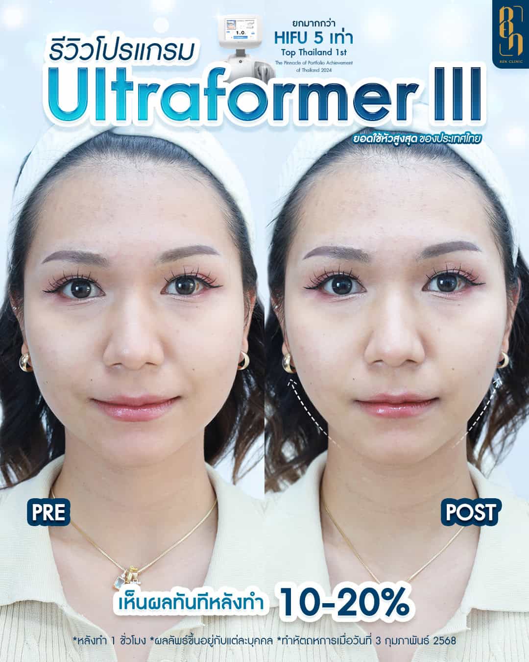 รีวิว Ultraformer