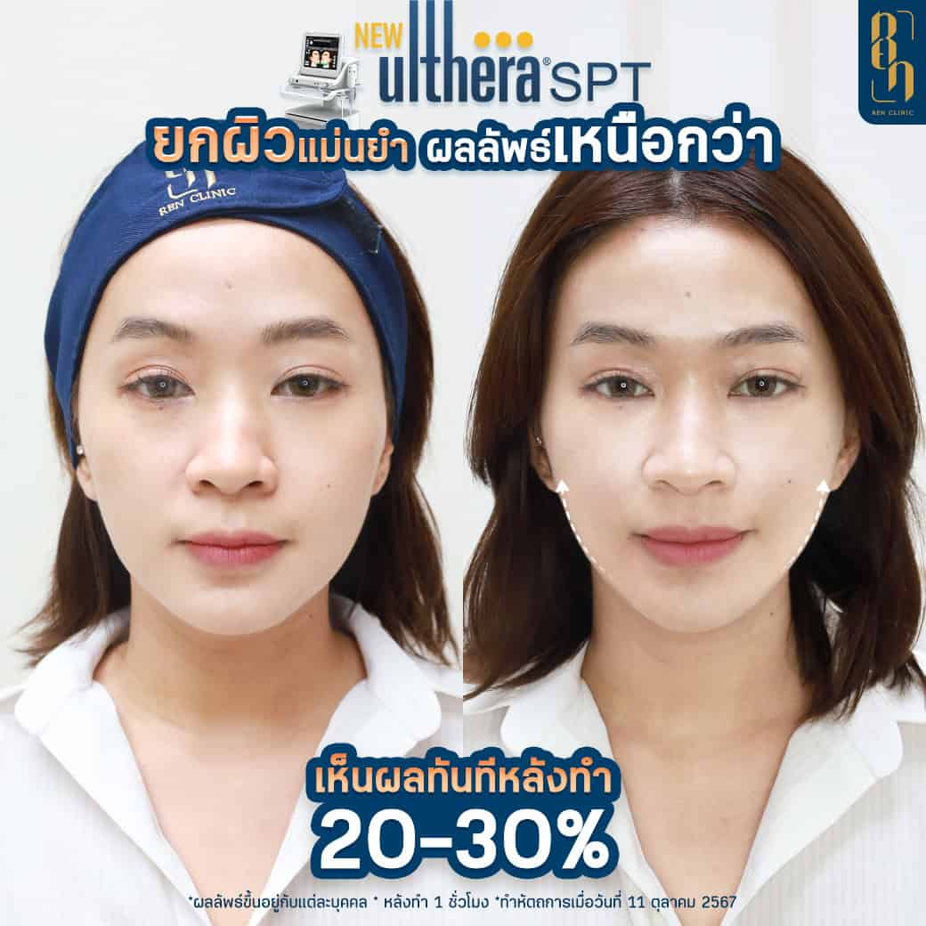 Ulthera กับ Ultraformer