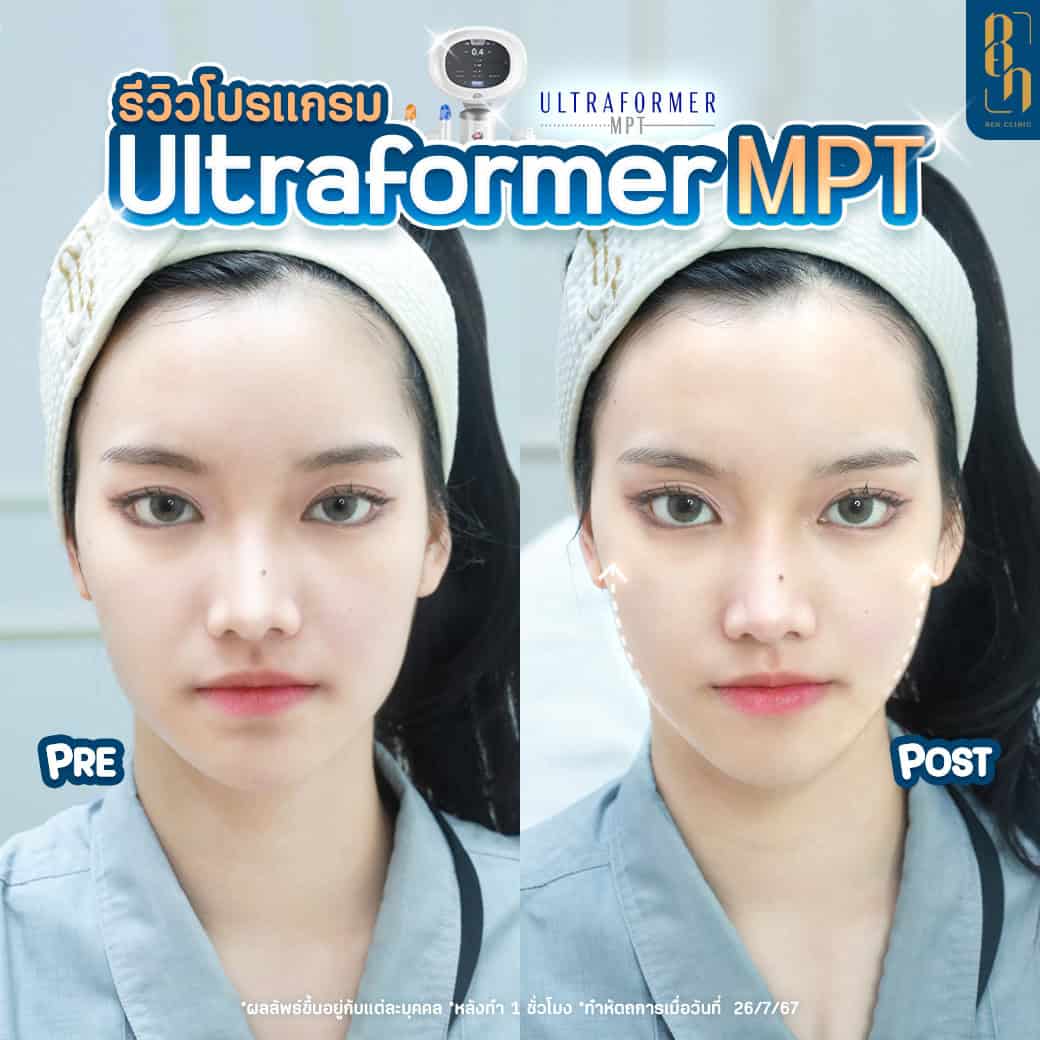 Ultraformer VS. Ultherapy