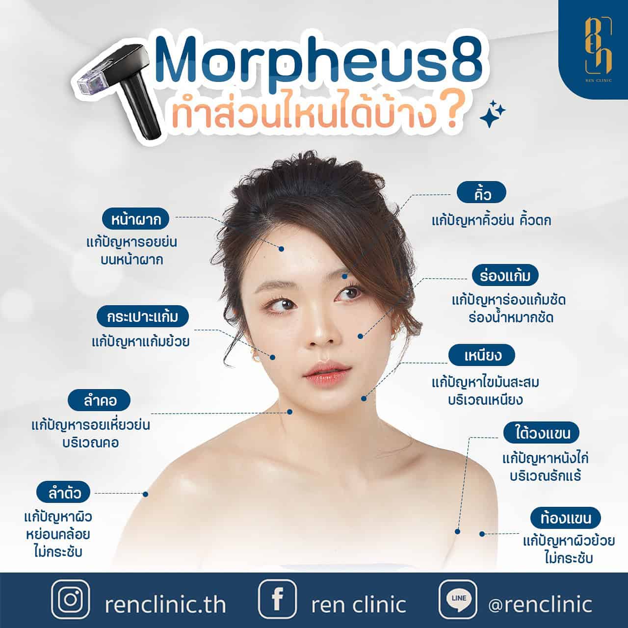 Morpheus8 ทำบริเวณไหนได้บ้าง