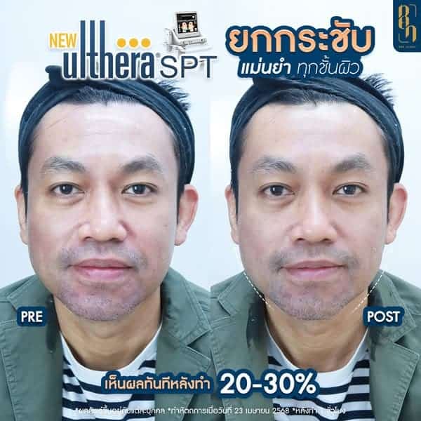 New Ulthera SPT