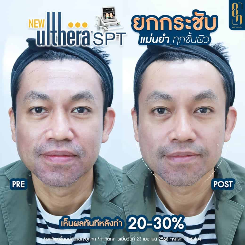 รีวิว Ulthera