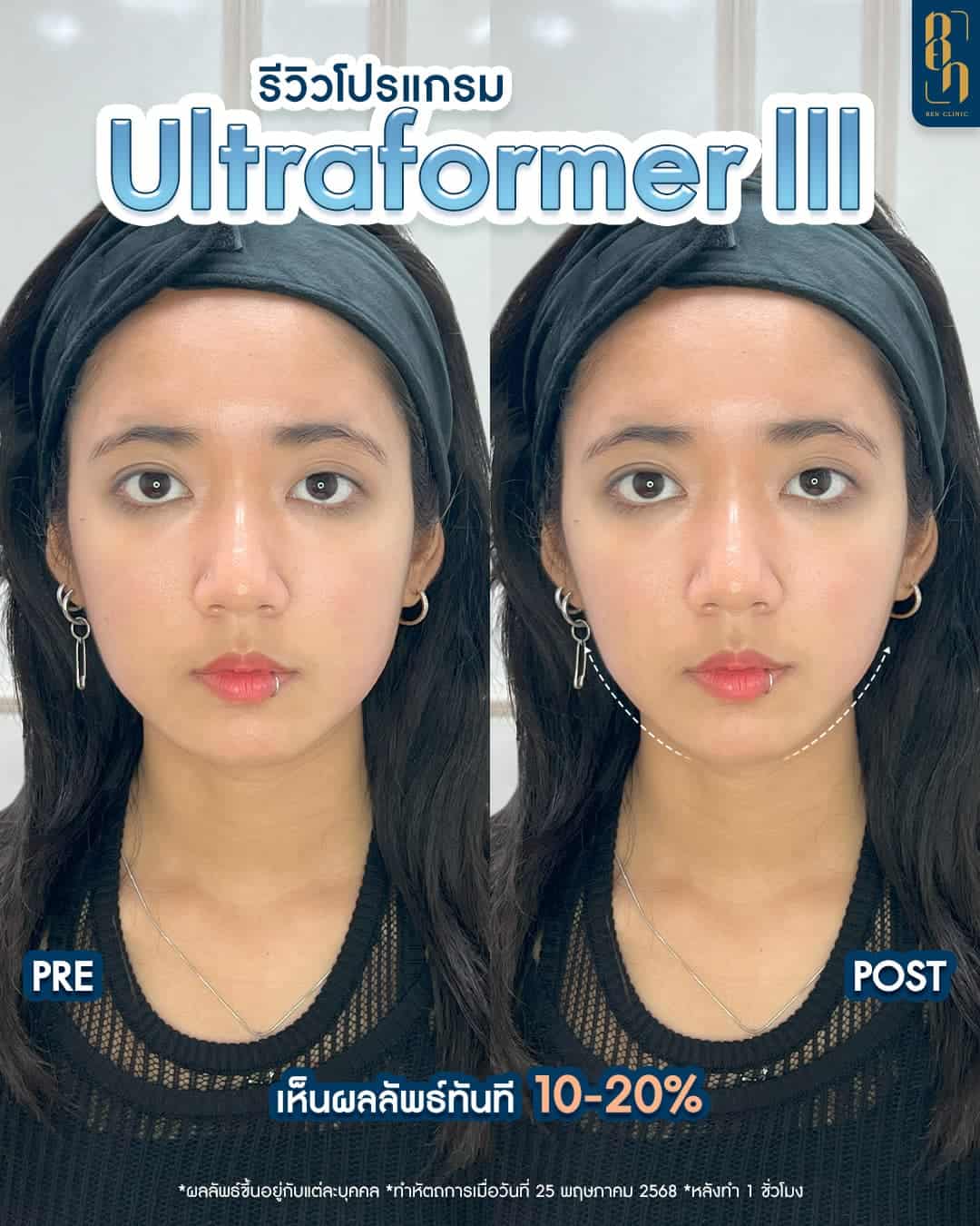 Ultraformer III บวมกี่วัน
