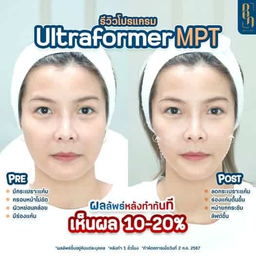 HIFU ทําได้บ่อยแค่ไหน