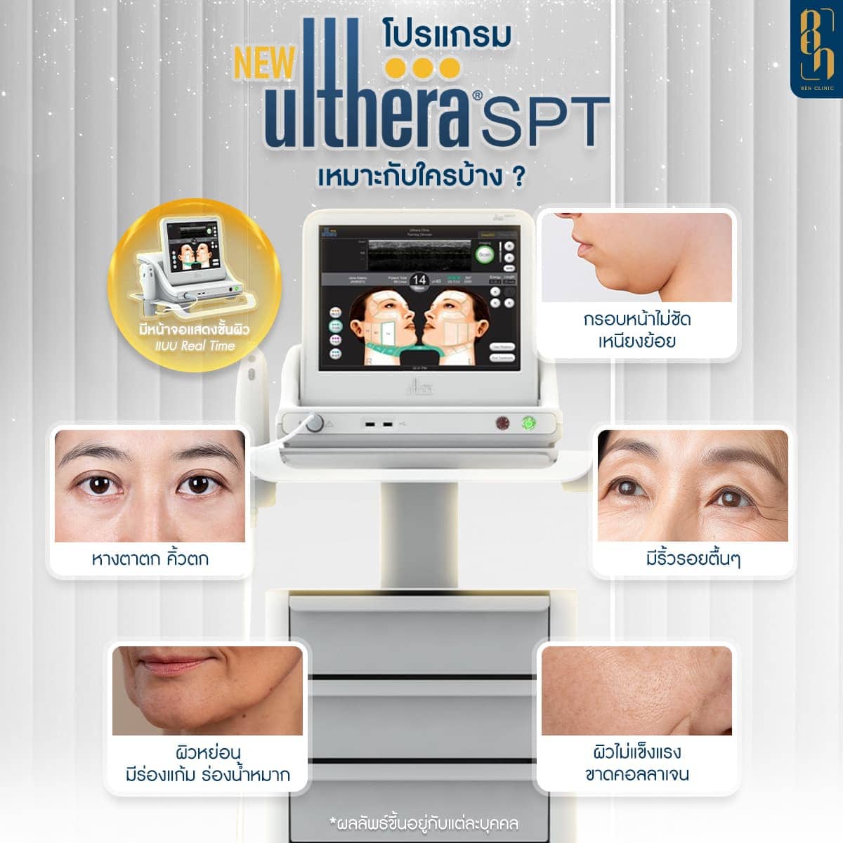 โปรแกรม HIFU เครื่อง Ulthera spt