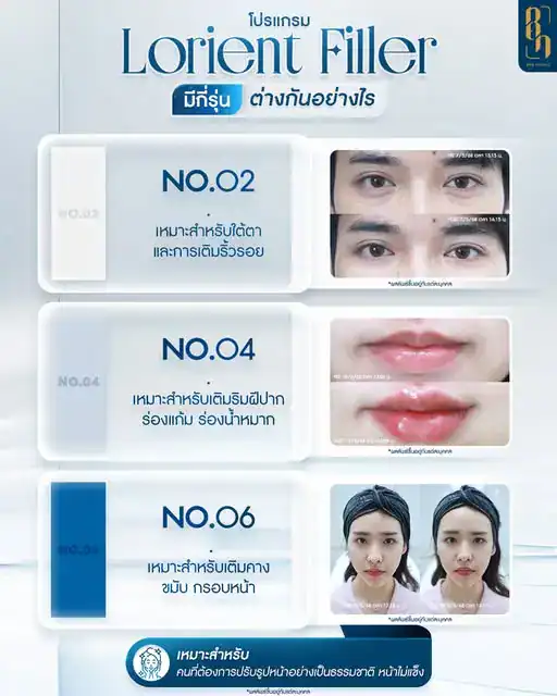 ฟิลเลอร์ยี่ห้อไหนดี