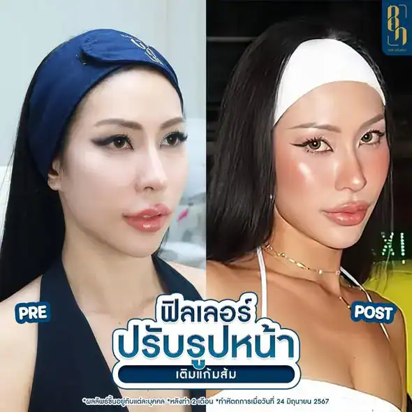 รีวิวฟิลเลอร์4