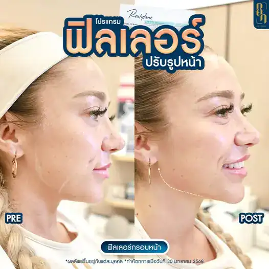 รีวิวฟิลเลอร์6