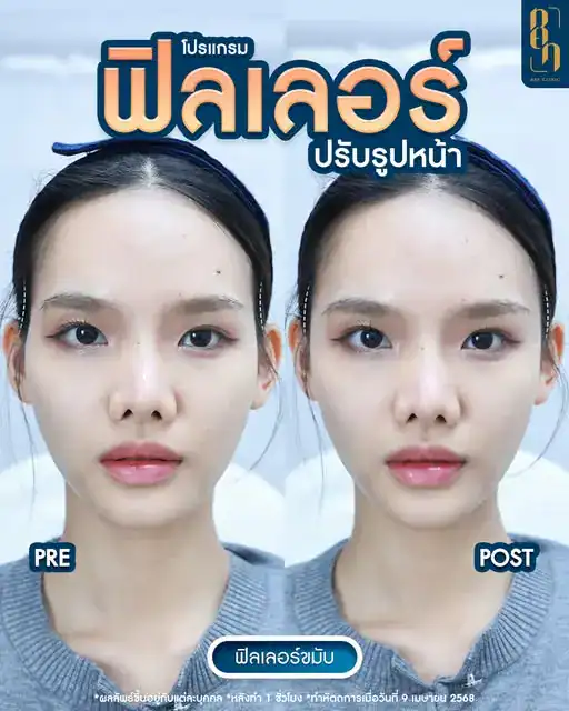 รีวิวฟิลเลอร์7