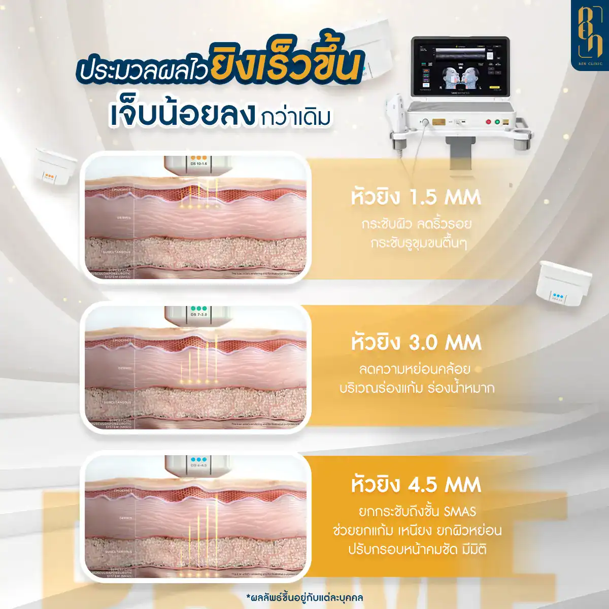 บริเวณที่ทำ Ulthera ได้