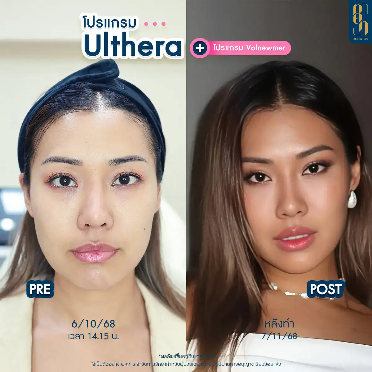 รีวิว Ulthera Prime