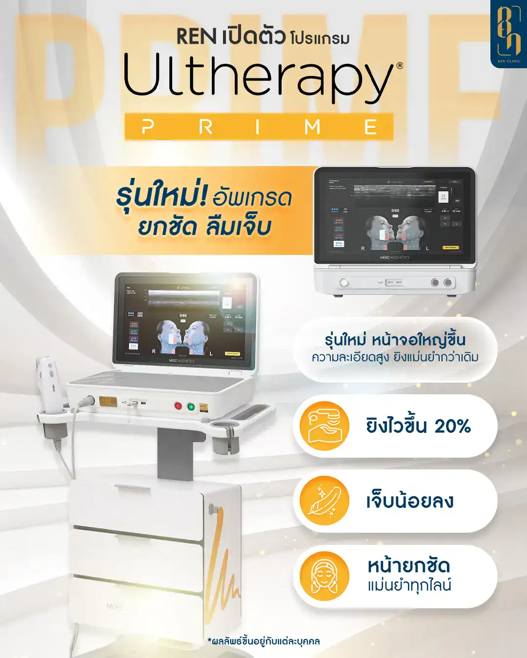 Ulthera Prime รีวิว