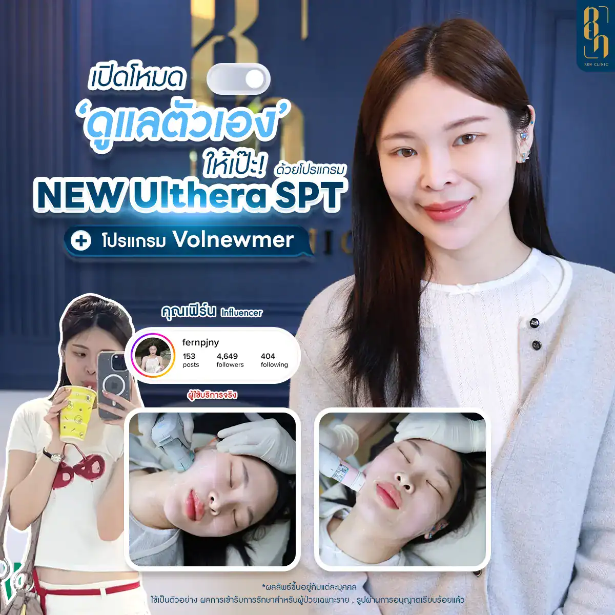 หลังทำโปรแกรม Ulthera