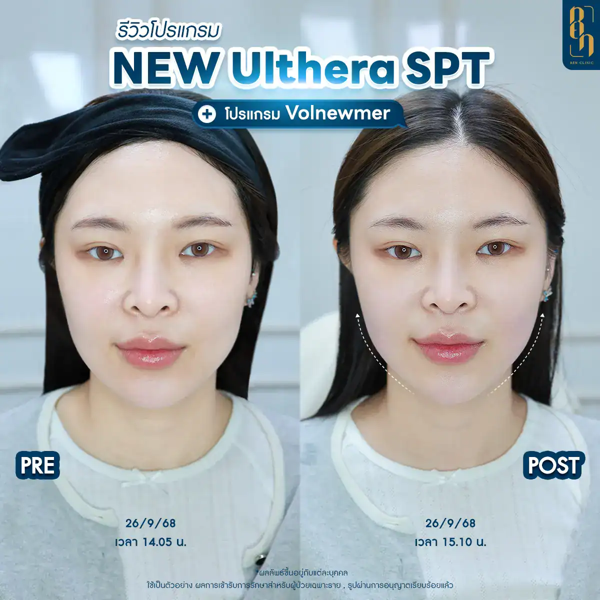 โปรแกรม Ulthera อยู่ได้นานแค่ไหน