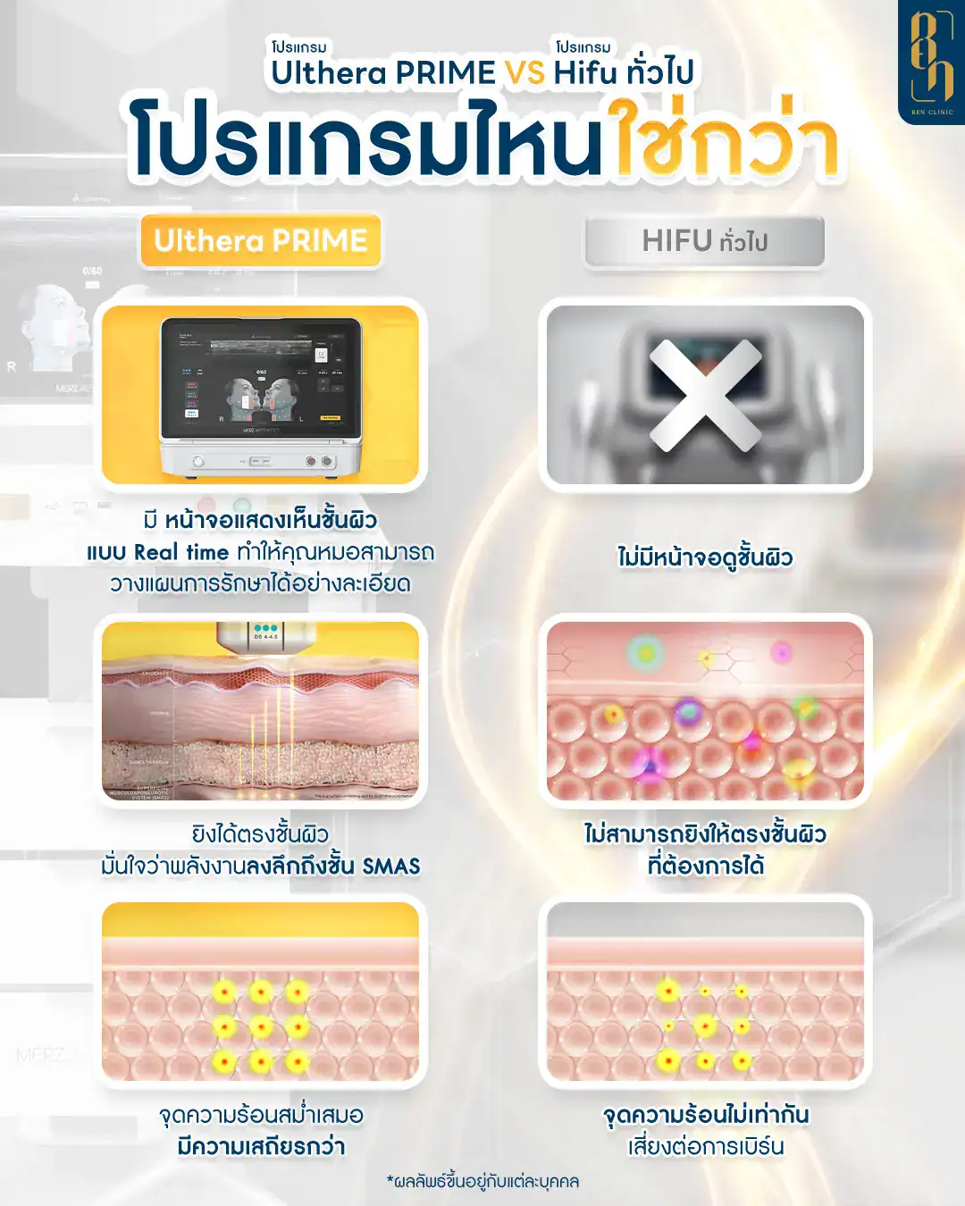 ทํา ulthera แล้วเจ็บ