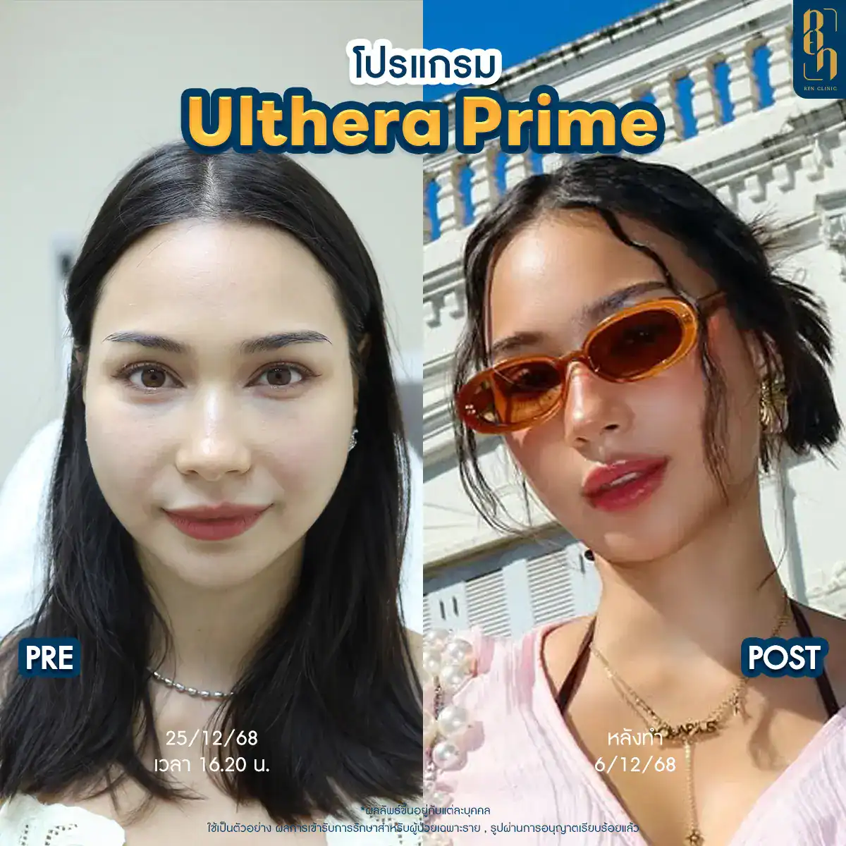 Program Ulthera SPT vs Program Ulthera Prime difference