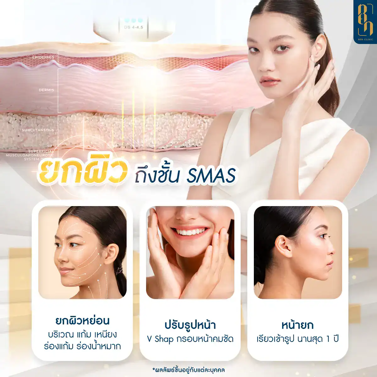 Ulthera prime vs Ulthera SPT difference