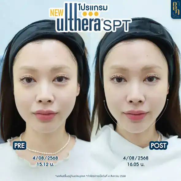Ulthera SPT vs Ulthera Prime