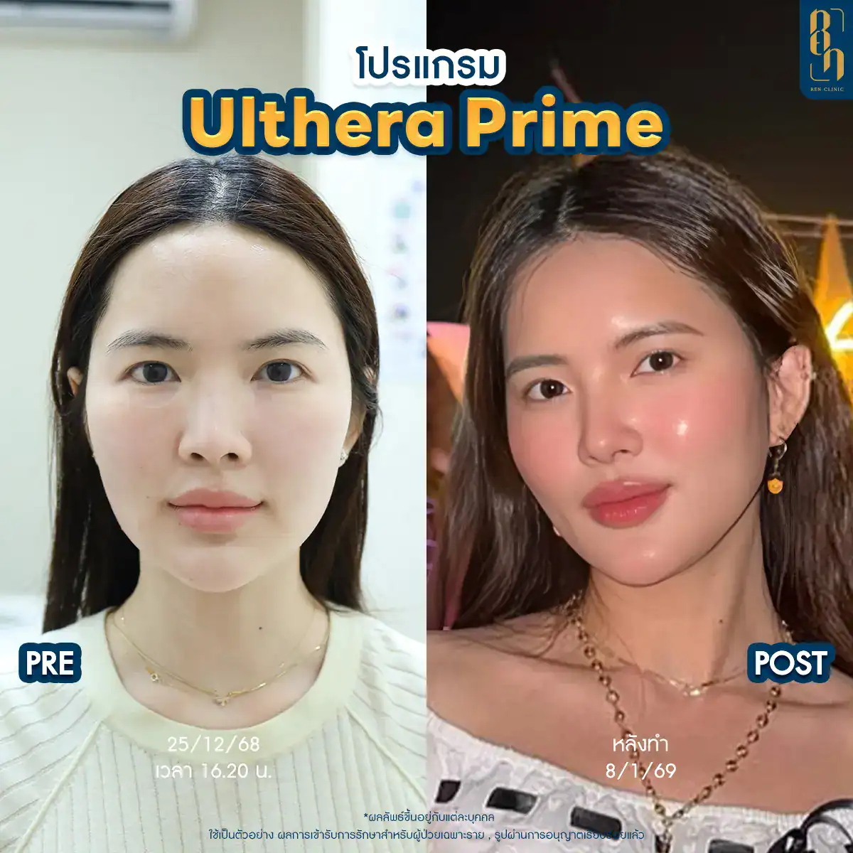 Ulthera SPT vs Ulthera Prime ต่างกันยังไง