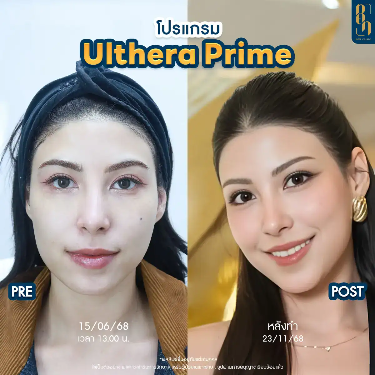 Ulthera SPT vs Ulthera Prime difference