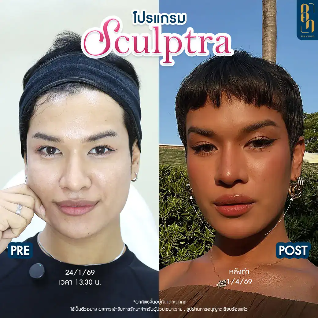 เพิ่มคอลลาเจนให้ผิวหน้า