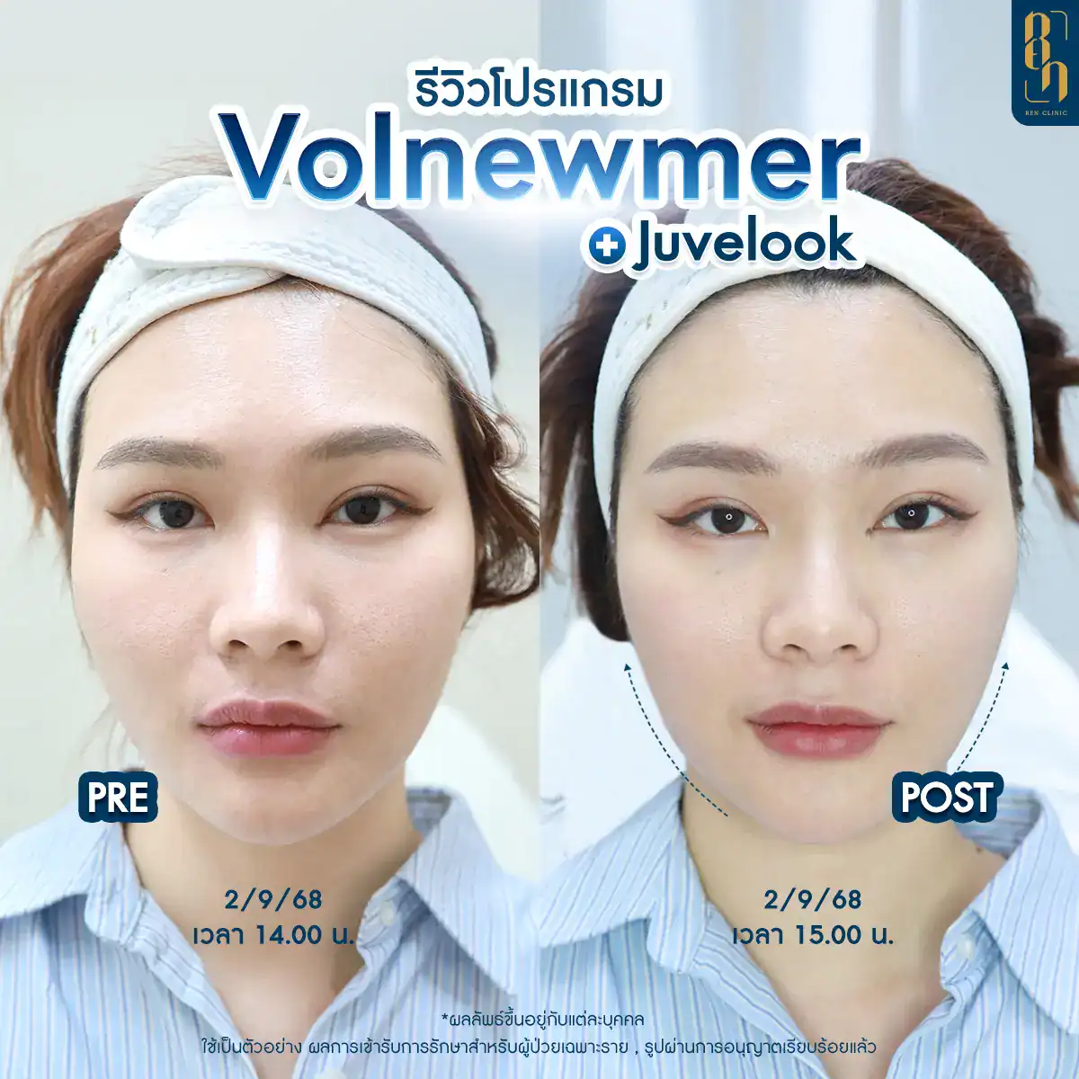 กระชับรูขุมขน คลินิก