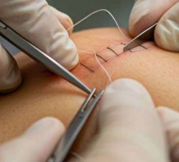 Suture removal